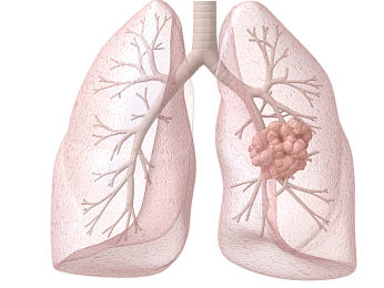 Лечение рака лёгких